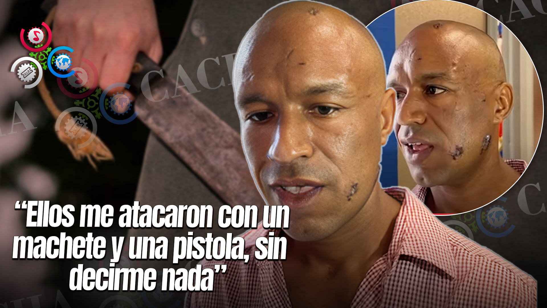 Hombre Denuncia Brutal Ataque A Machetazos Por Dos Individuos En San Francisco De Macorís