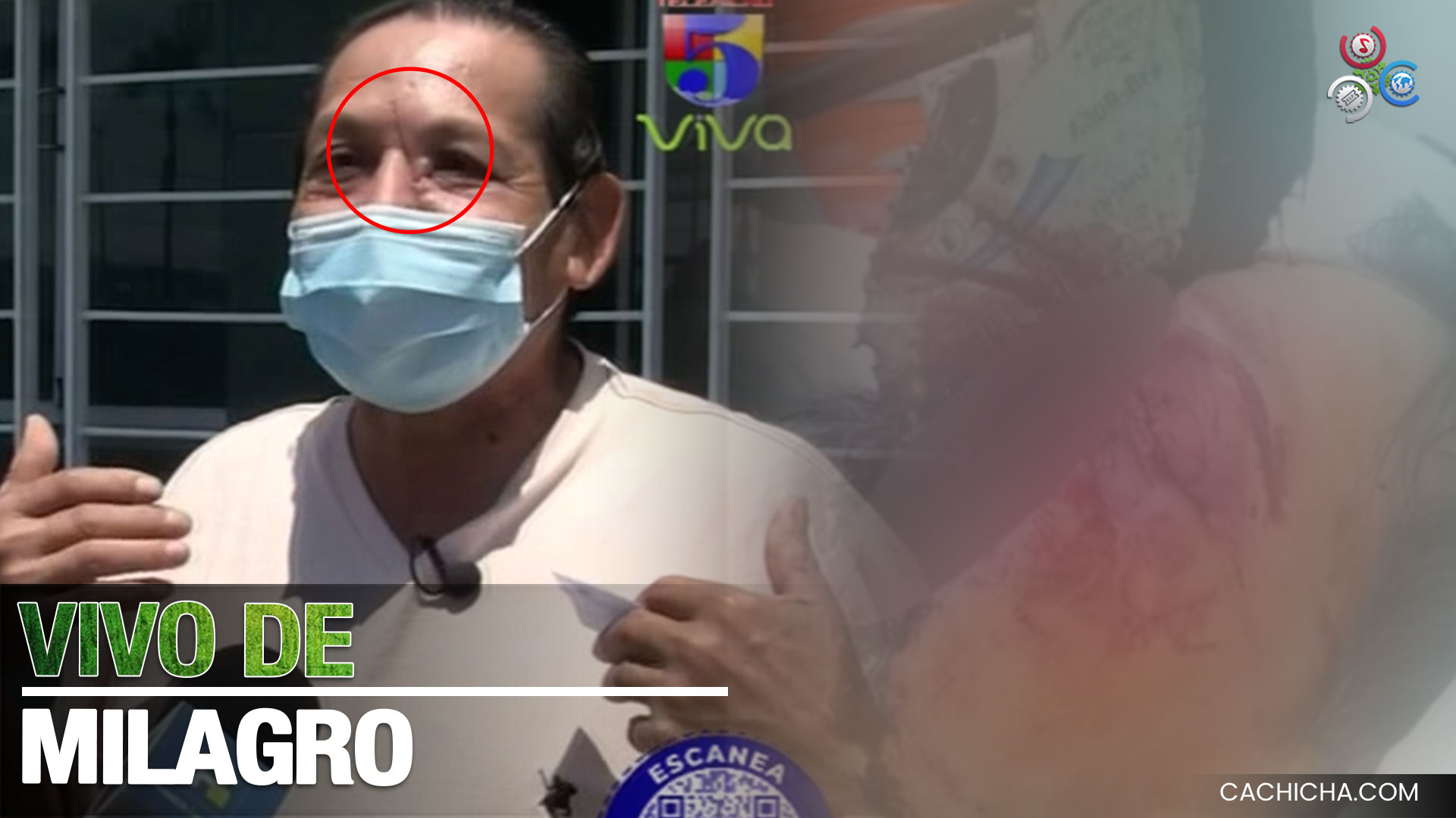 Disco De Sierra Industrial Se Le Incrusta En La Cara Y Vive Para Contarlo