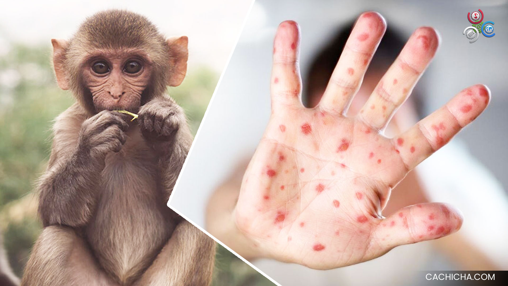 Al Menos 80 Países Reportan Casos De Viruela Del Mono