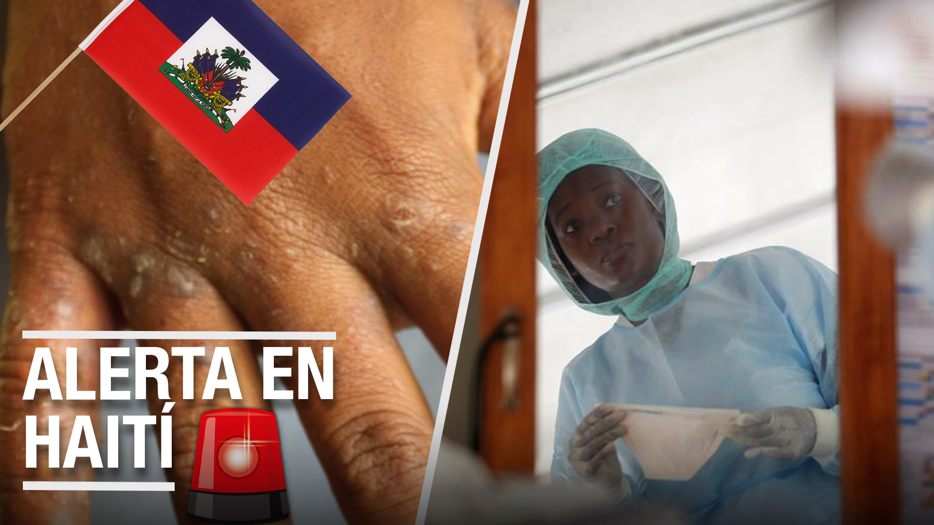 Alerta Epidemiología Por Brote De Sarna En Haití | ¿Un Riesgo Para República Dominicana?