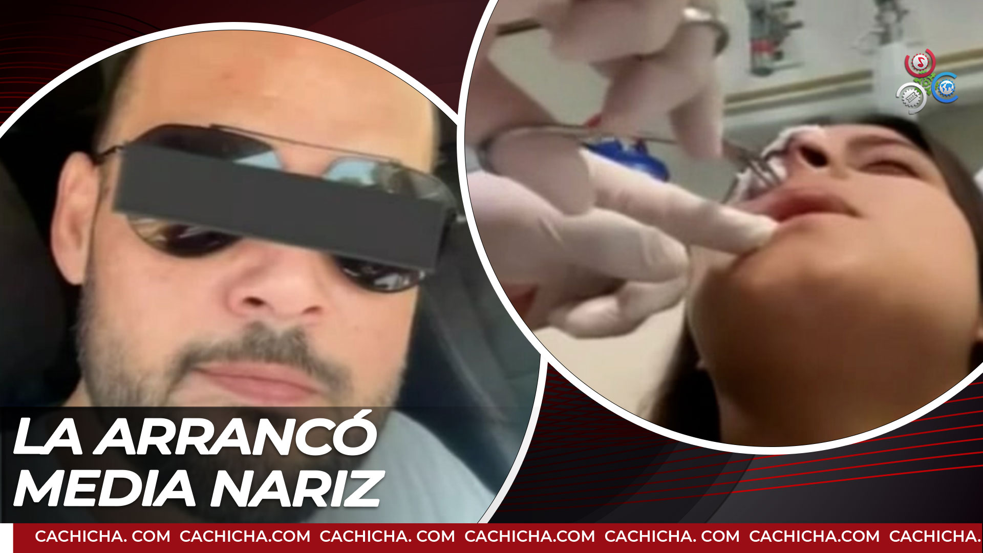 Hombre Le Arranca “a Mordidas” La Nariz A Mujer