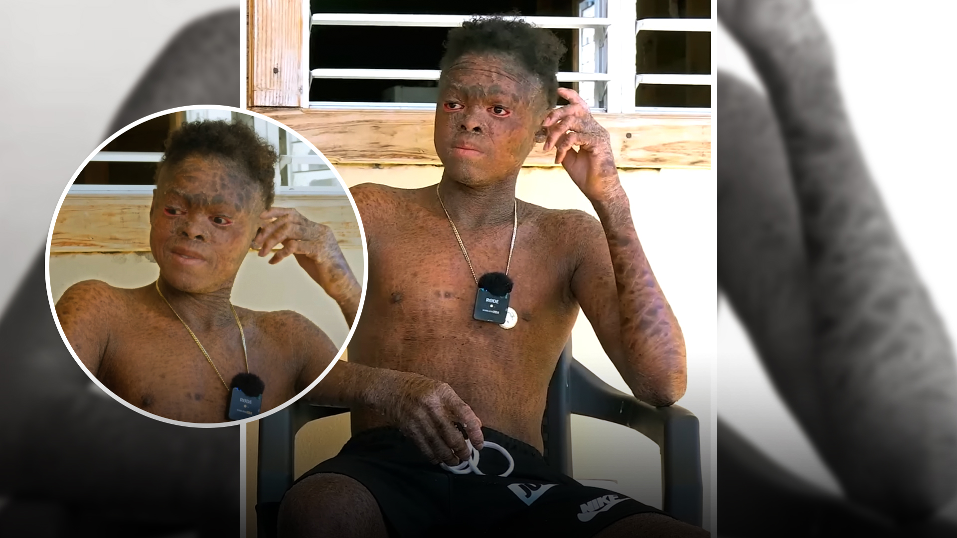 ¡UN AMARGO RECHAZO! Joven Con “Piel De Pescado” Cuanta Lo Difícil Que Ha Sido Su Vida