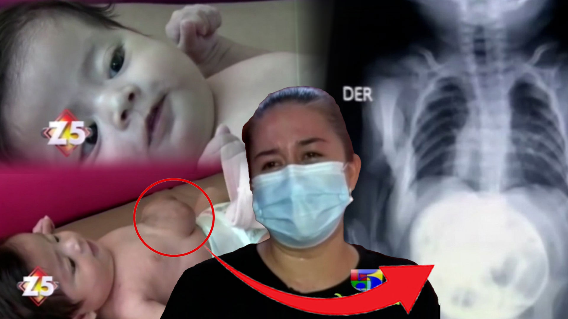 ¡Insólito! Bebé Guatemalteca Nace Con El Corazón Afuera, Doctores Le Dan Pocas Probabilidades De Vida