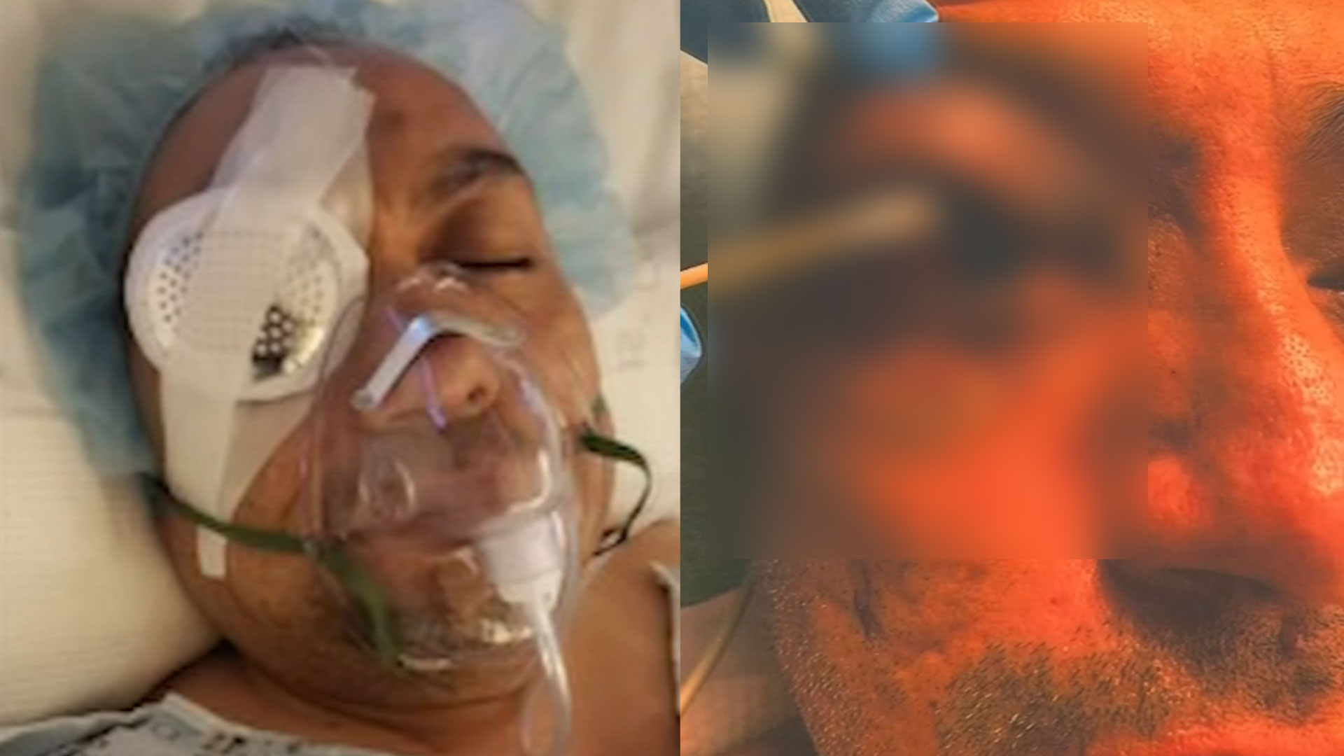 Hombre Pierde El Ojo En El Momento Que La Policía Lo Arresta En Su Casa  