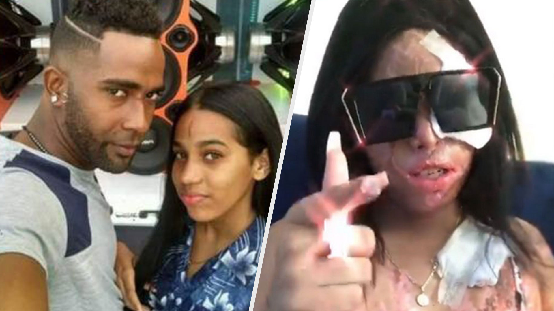 Pide Perdón El Acusado De Rociarle ácido Del Diablo A La Joven Yocairi Amarante 