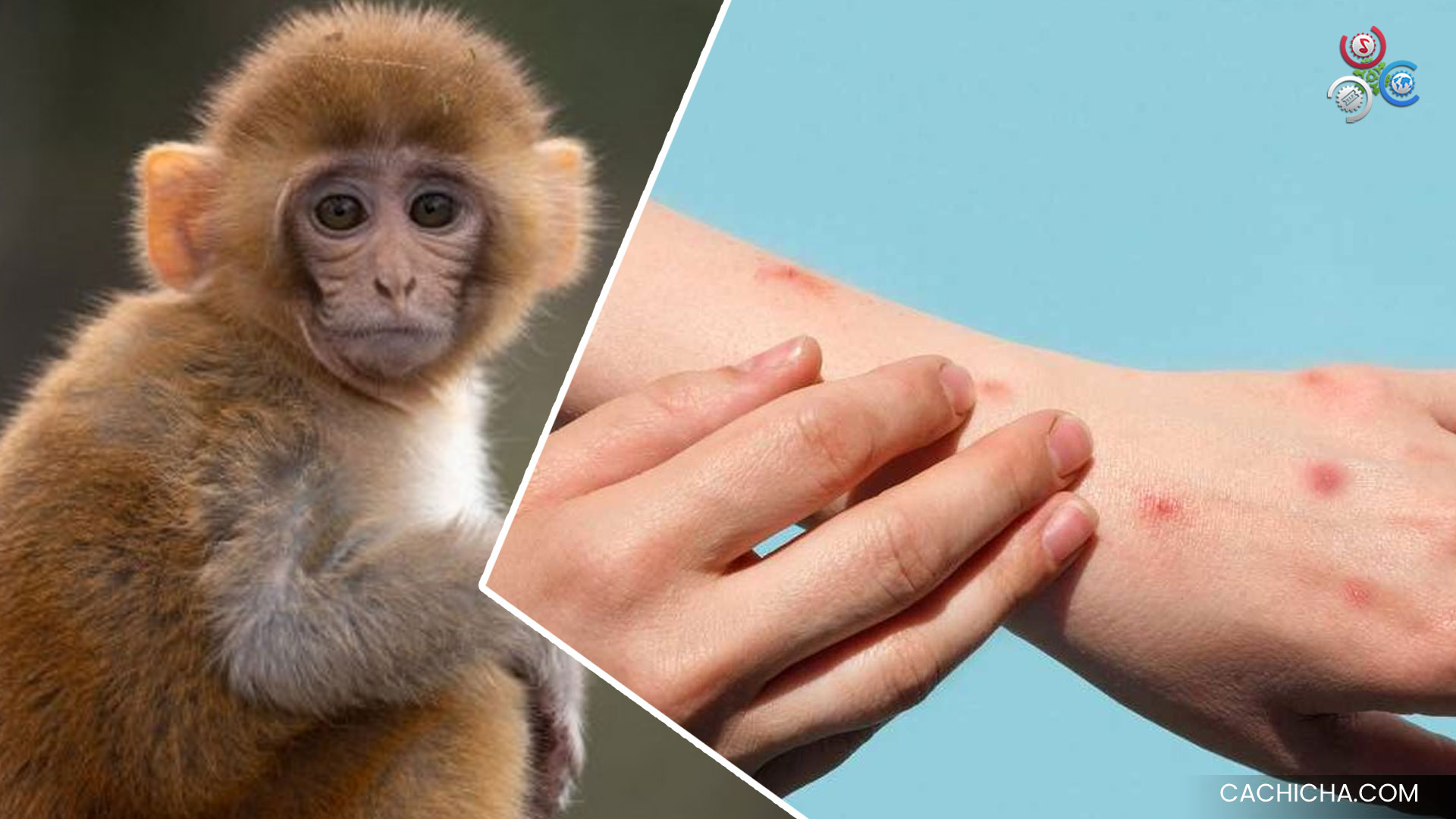 Joven Diagnosticado Con Viruela Del Mono Recibirá Alta Médica El Fin De Semana