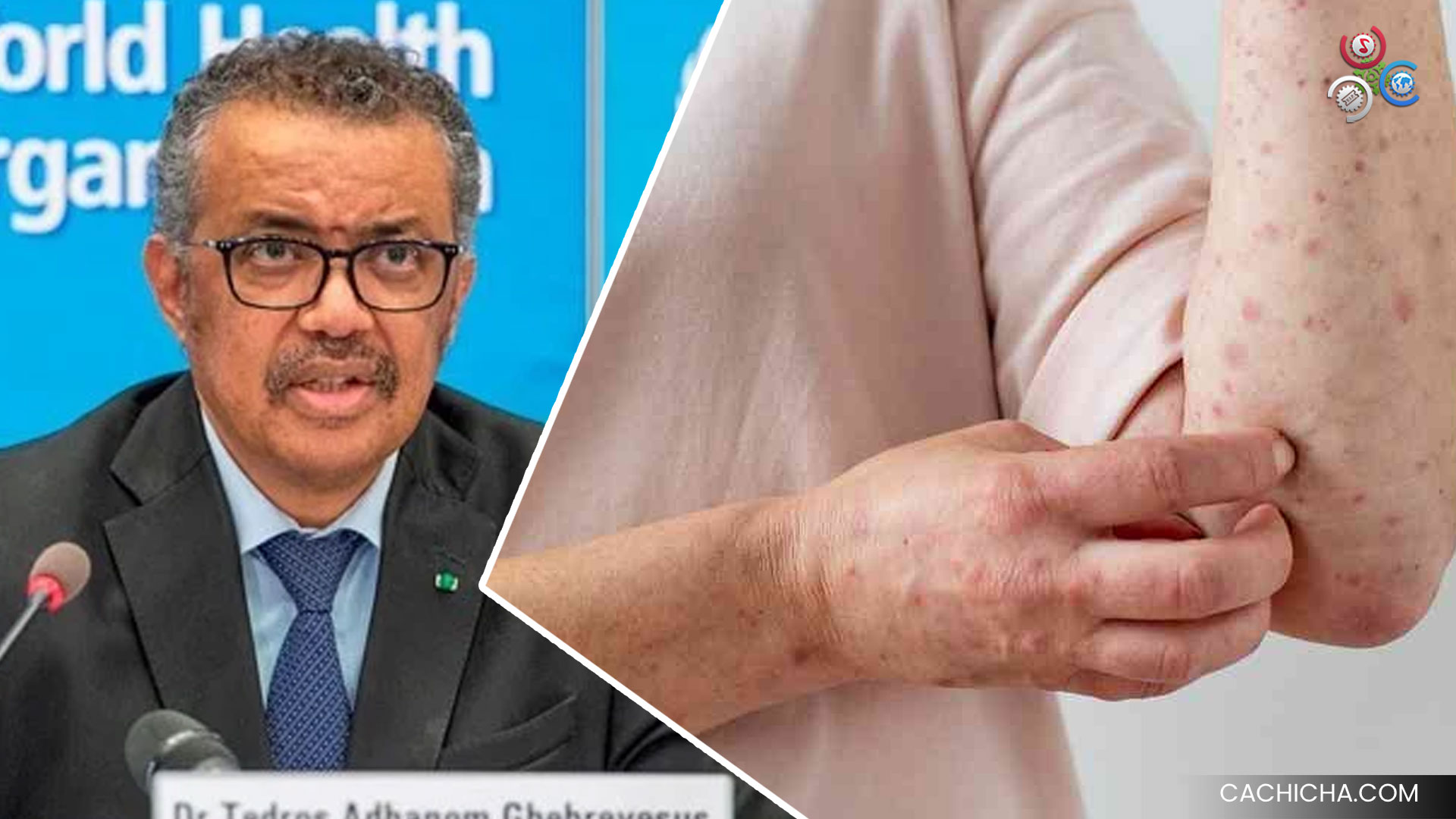 OMS Estudia Si La Viruela Del Mono Amerita Nivel De Alerta Máxima