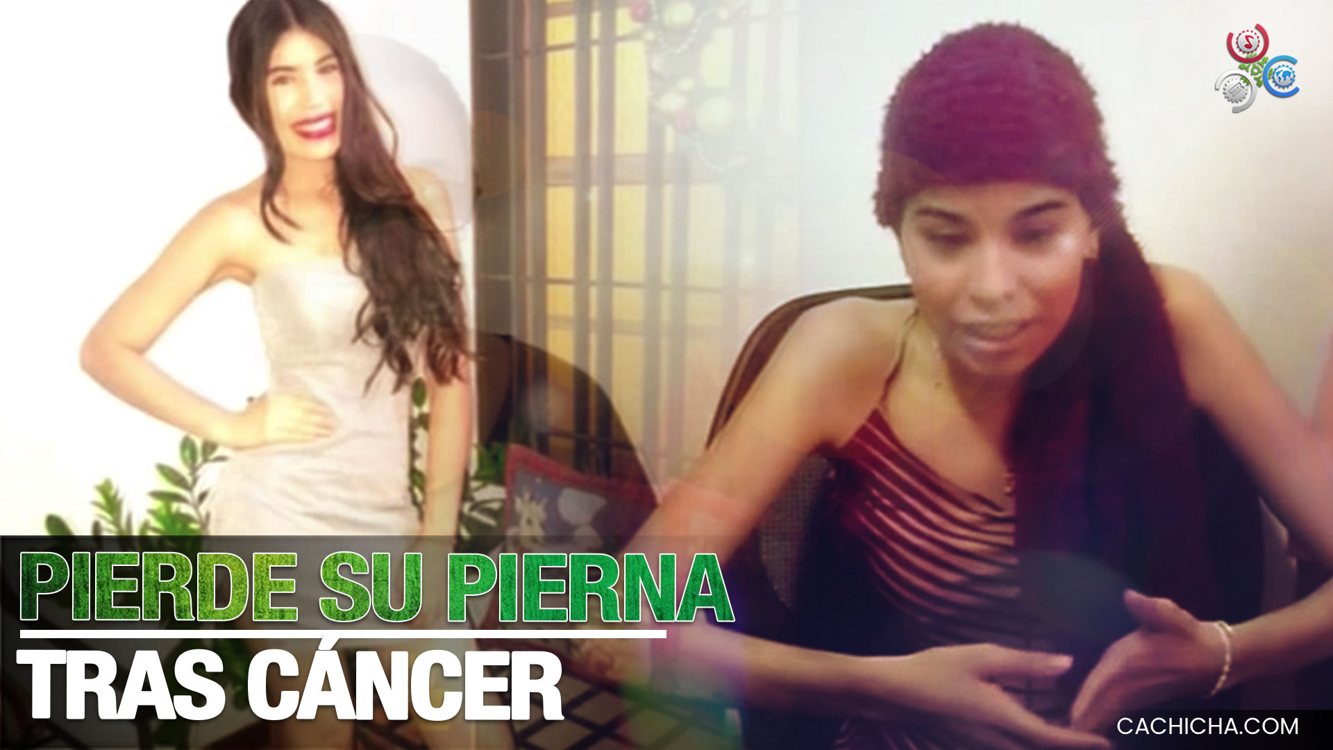 Adolescente De 19 Años Pierde Su Pierna Tras Diagnosticarle Un Cáncer