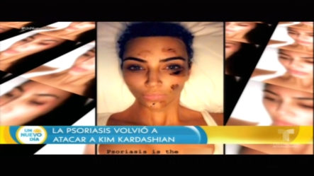 Kim Kardashian Publica Imágenes Mostrando La Enfermedad De La Piel Que Padece