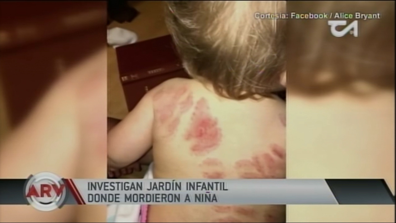 Investigan Jardín Infantil Donde Mordieron A Niña