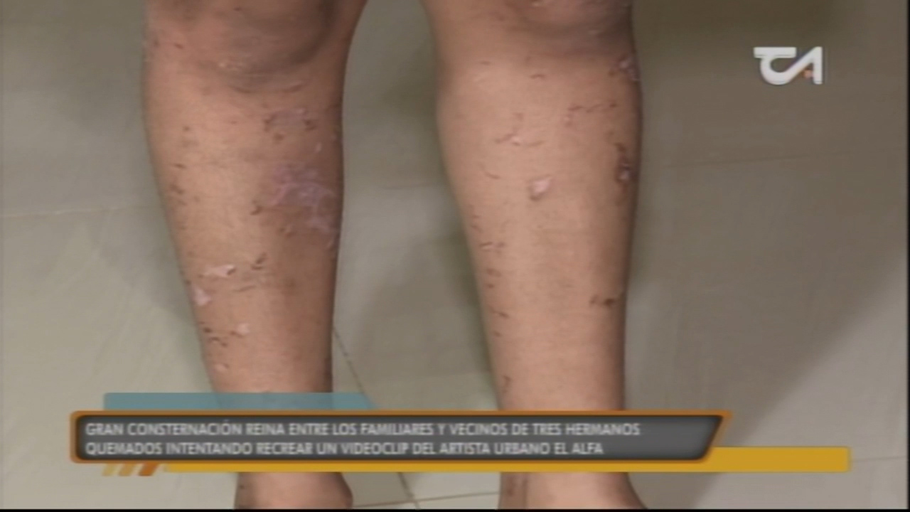 Consternación Entre Los Familiares De Niños Quemados Tras Recrear Video Del ALFA