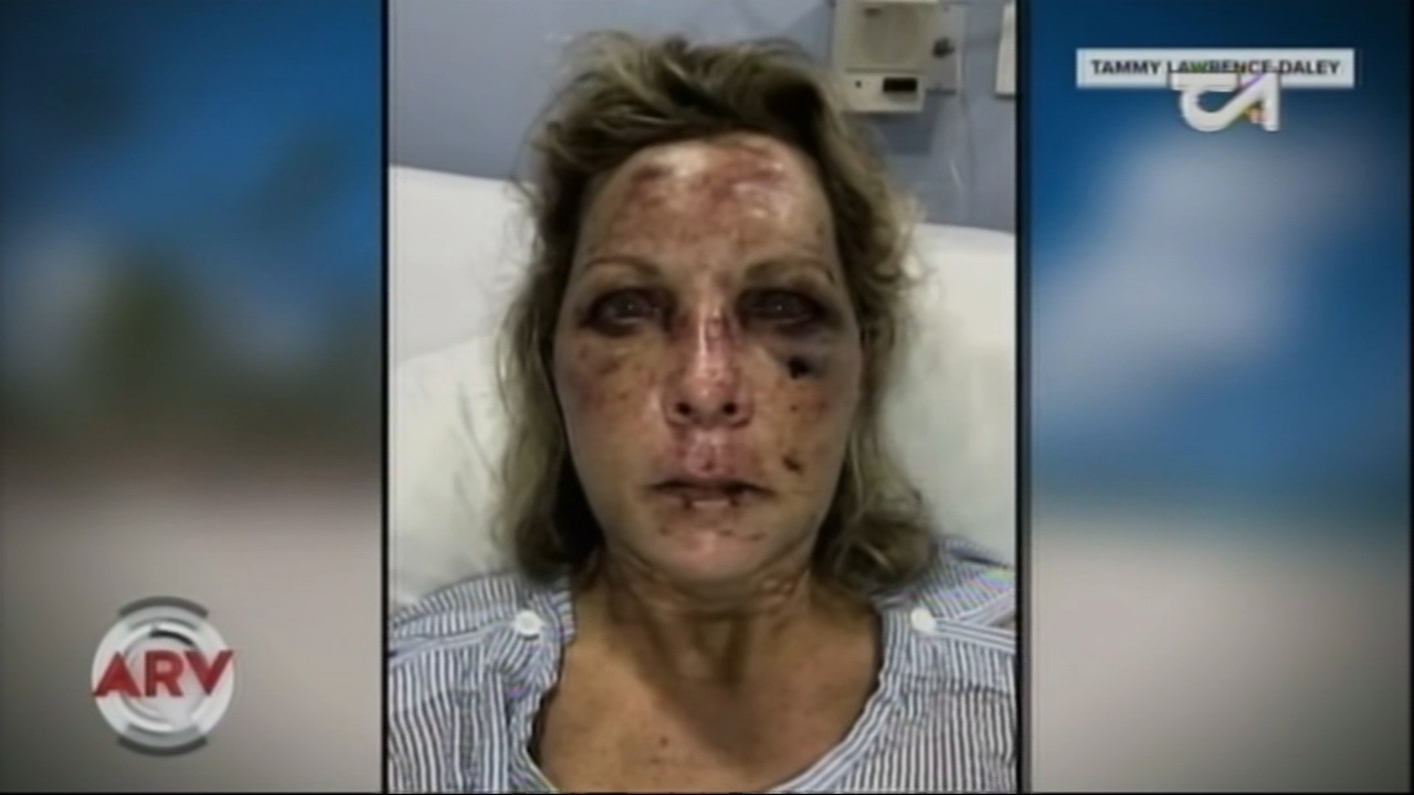 Primeras Declaraciones De Mujer Estadounidense Que Fue Atacada En Un Hotel De Punta Cana