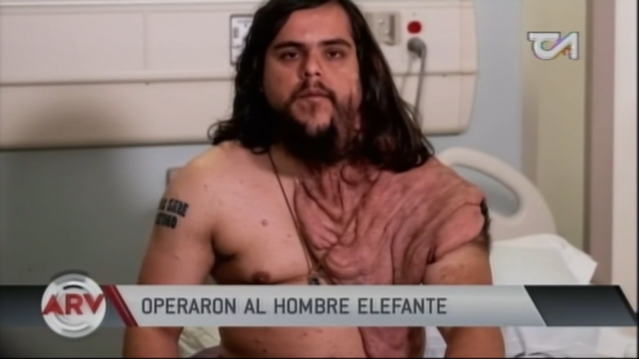 Operaron Al Hombre Elefante