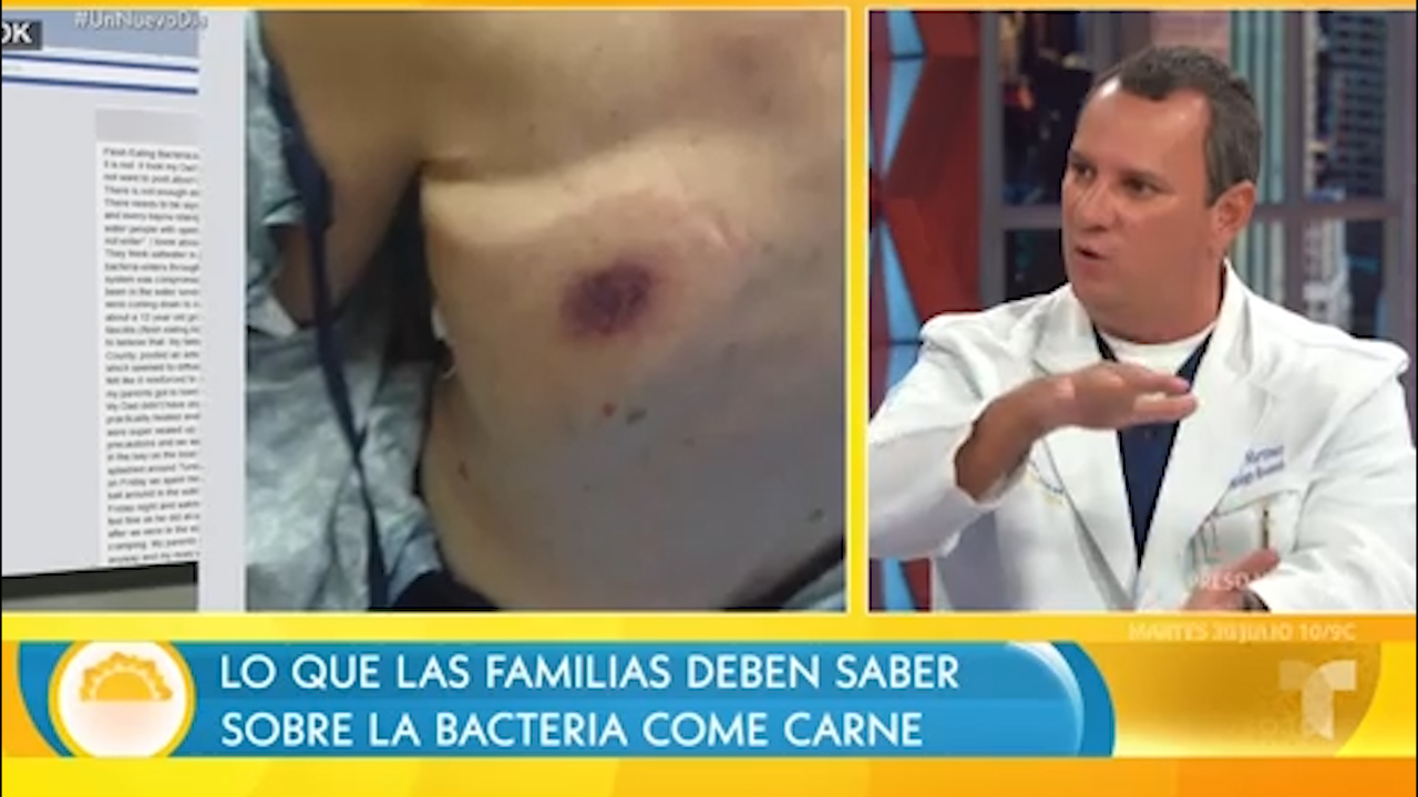 “Bacteria Come Carne” Amenaza Varias Playas De Estados Unidos