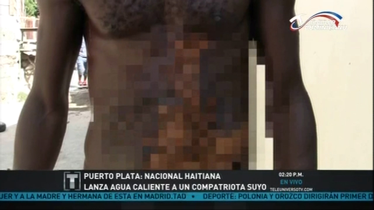 En Puerto Plata Nacional Haitiana Le Lanza Agua Hirviendo A Un Compatriota Suyo