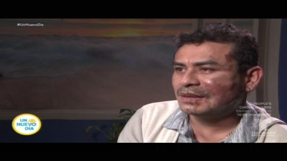 Esto Es Lo Que Dice El Hispano Que Le Lanzaron Acido Al Rostro