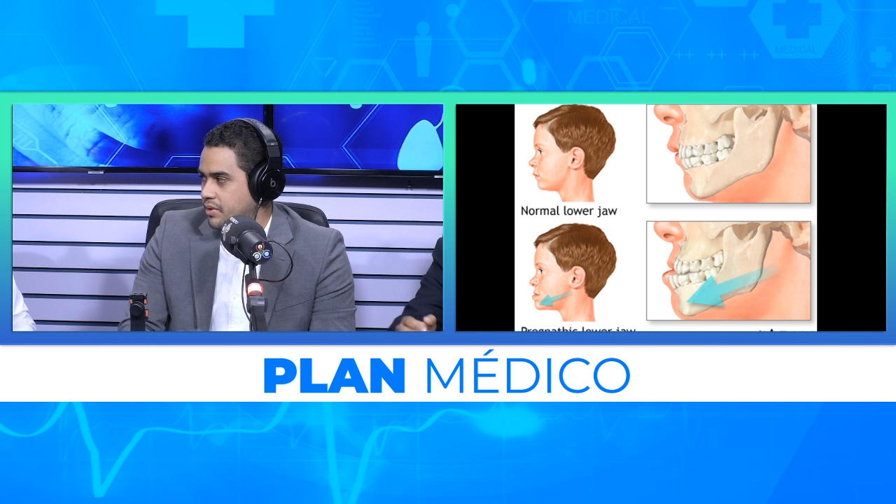 ¿Qué Es La Cirugía Ortognática O Cirugía Maxilar? | Plan Médico