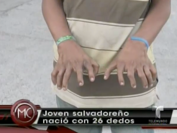 El Joven Salvadoreño Que Nació Con 26 Dedos, Con 6 En Cada Mano Y 7 En Cada Pie #Video