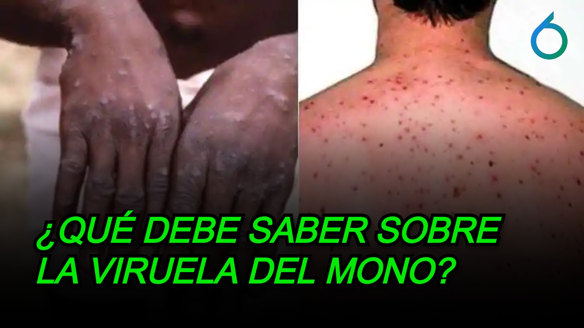 ¿Qué Debes Saber Sobre La Viruela Del Mono? | 6to Sentido