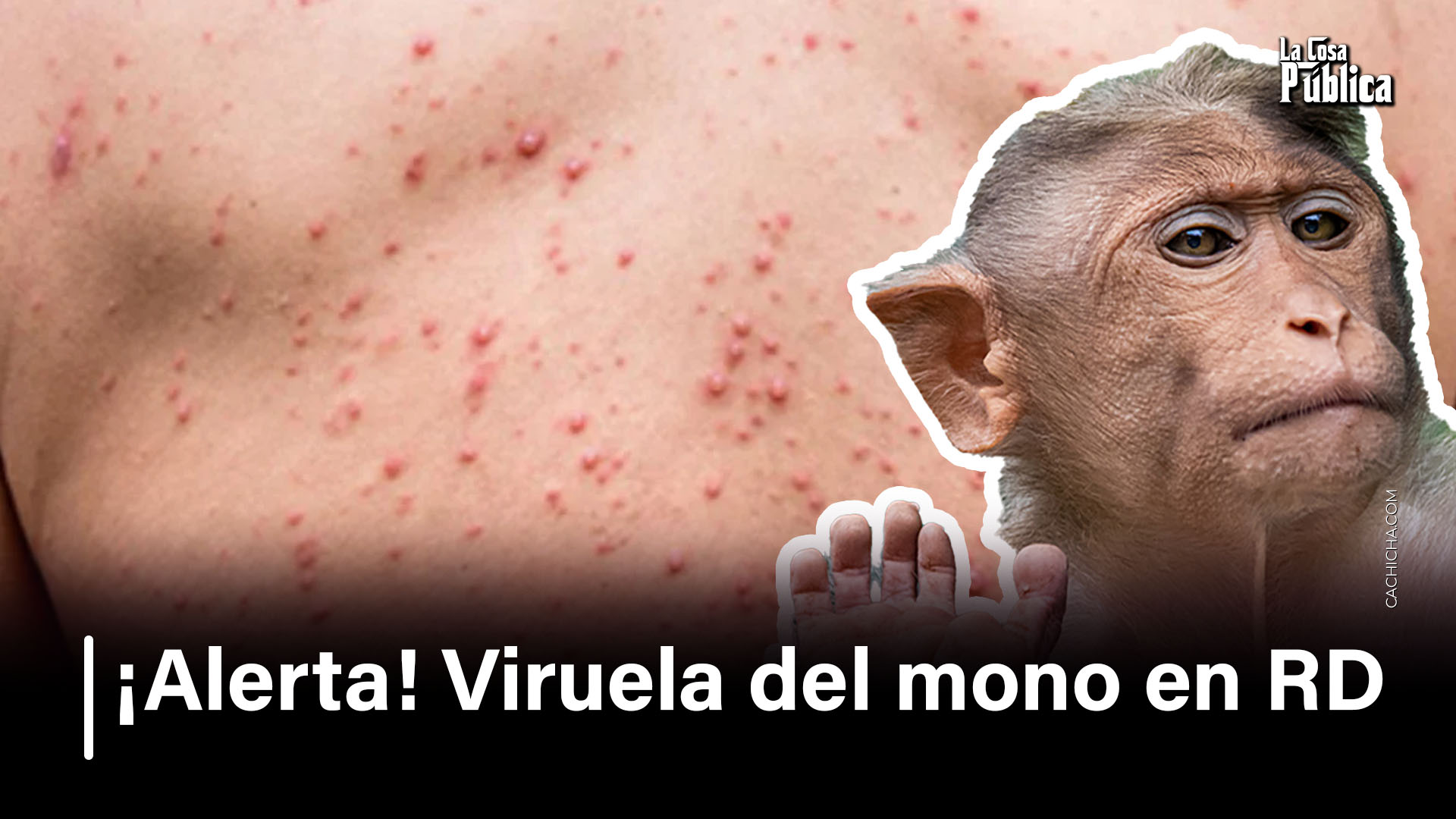 ¡Alerta! Viruela Del Mono En RD