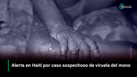 Alerta En Haití Por Caso Sospechoso De Viruela Del Mono