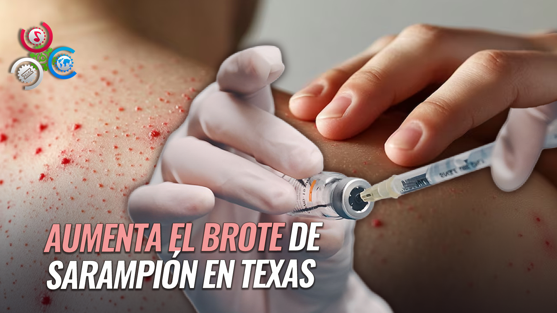 Brote De Sarampión En Texas: Más De 500 Casos Confirmados Y Alarma Por Contagios En Niños Pequeños