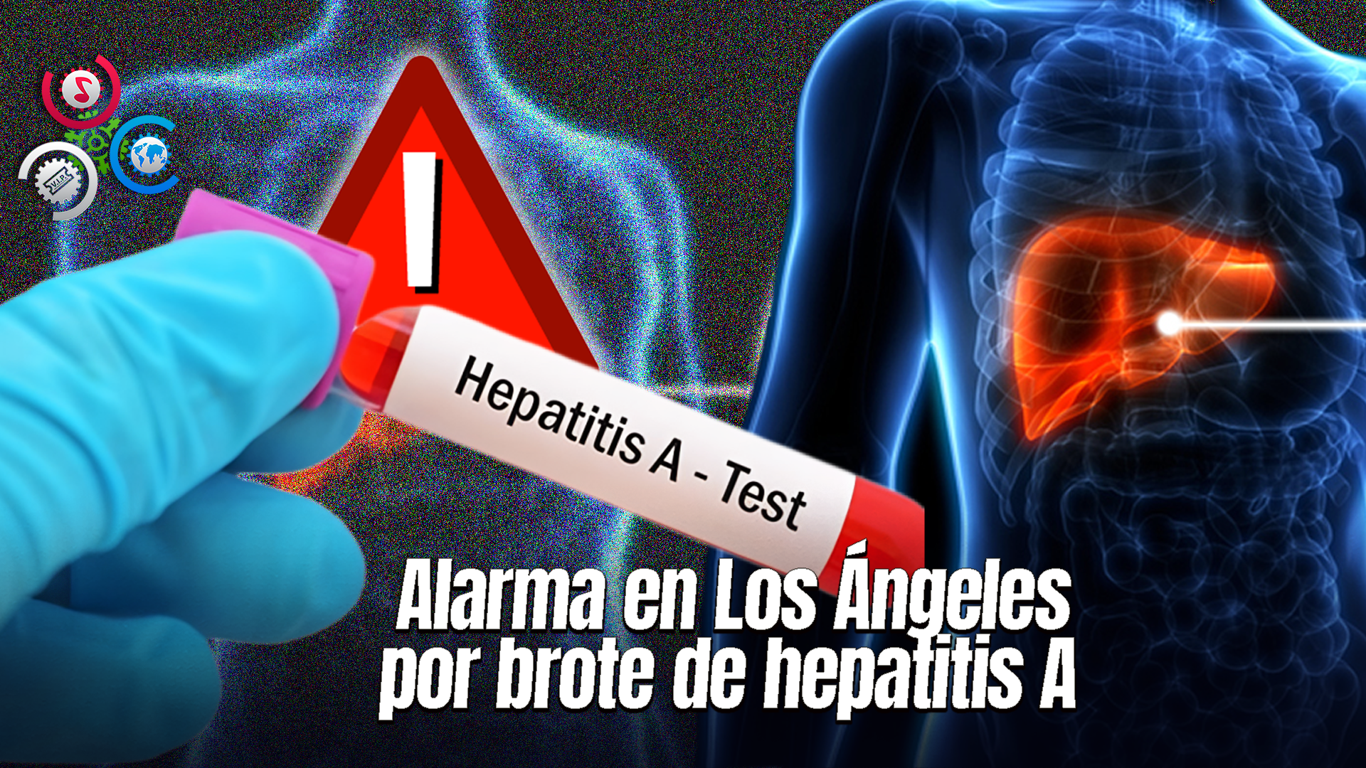 Autoridades En Alerta Por Brote De Hepatitis A En El Condado De Los Ángeles
