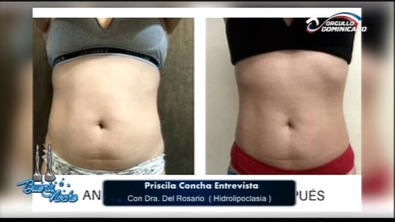 La Alternativa Más Segura De La Liposucción, La Hidrolipoclasia Y Sus Aplicaciones En Buena Noche