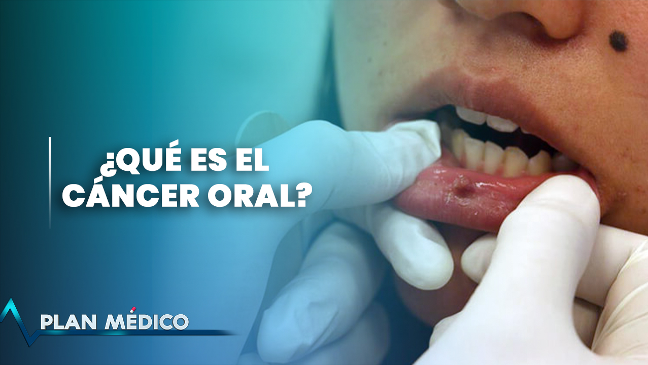 Cáncer Oral | Plan Médico (1/2)