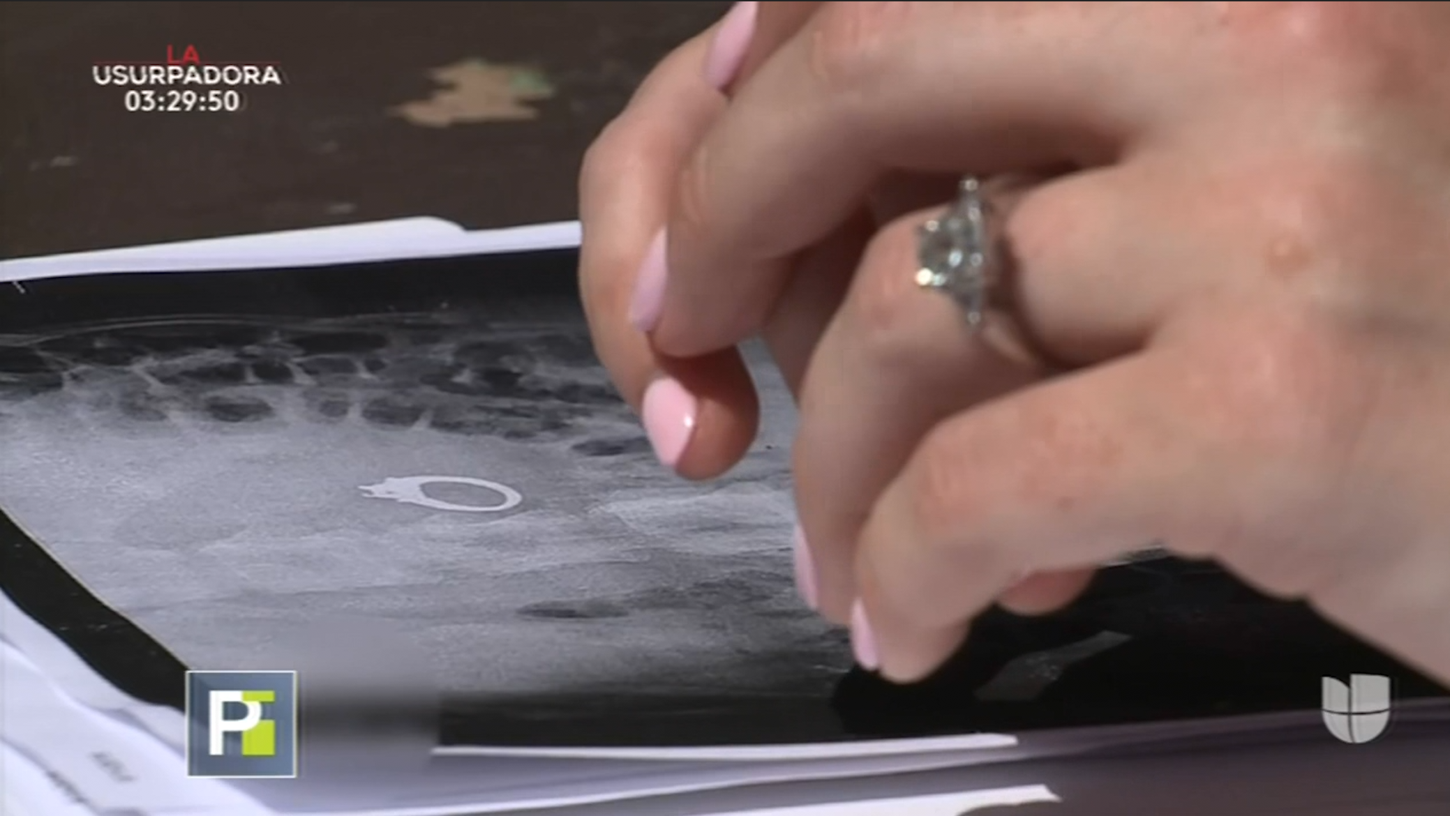 Mujer Sueña Que Se Traga Su Anillo De Compromiso Y No Era Un Sueño