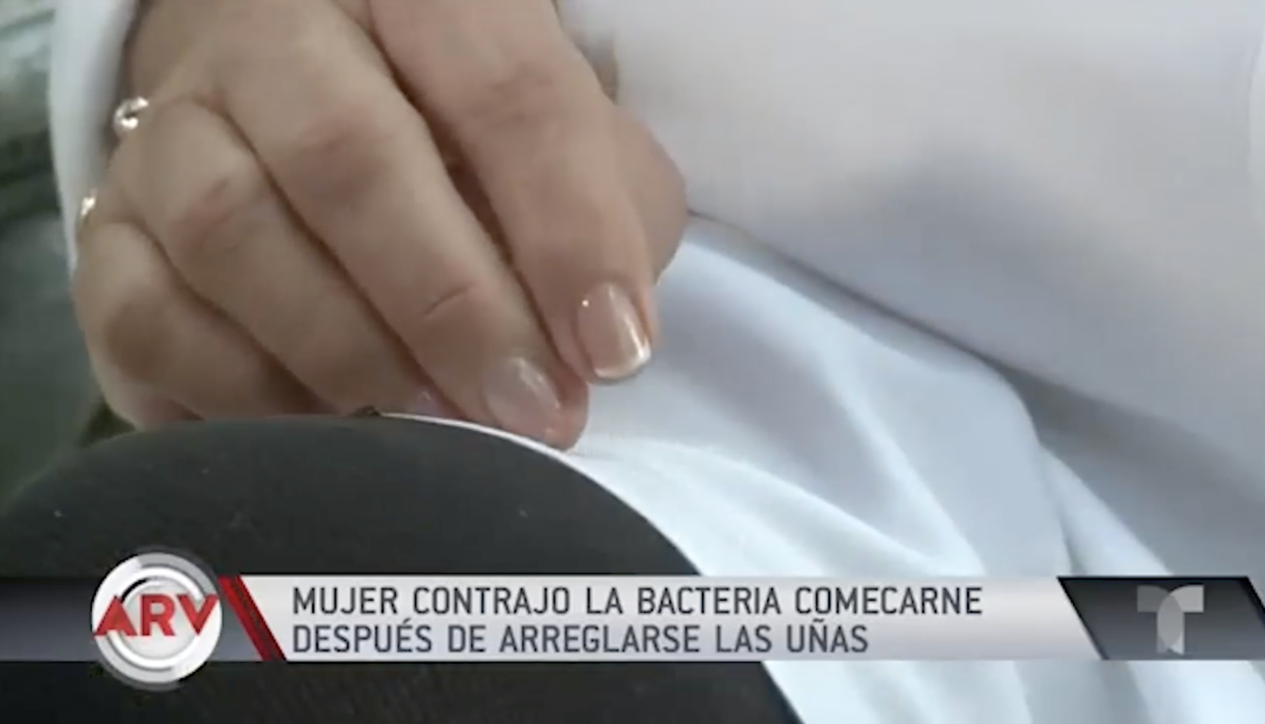 Mujer Casi Pierde La Mano Después De Realizarse Una Manicura