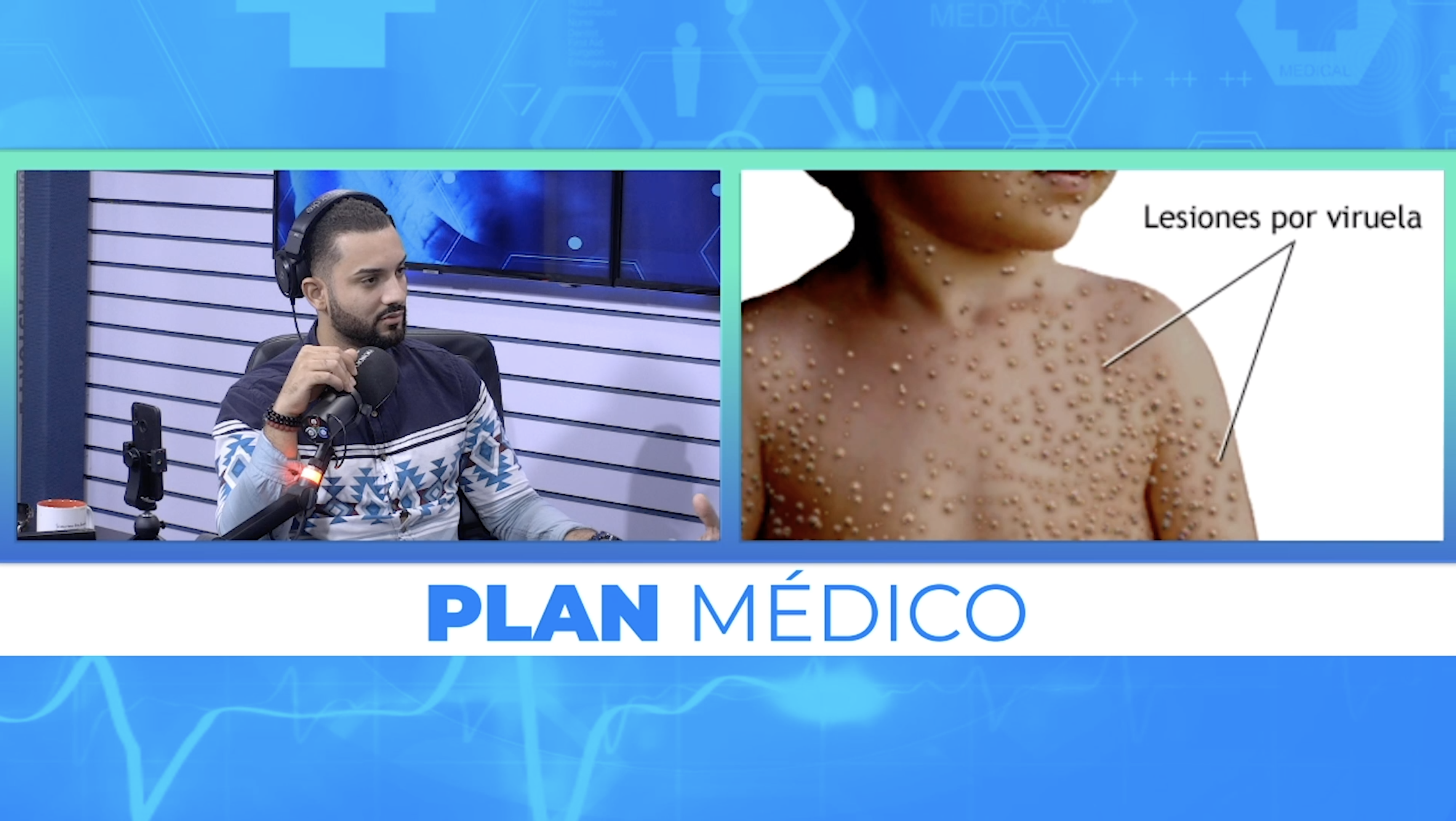 La Viruela: La Horrorosa Enfermedad Que Milagrosamente Fue Erradicada