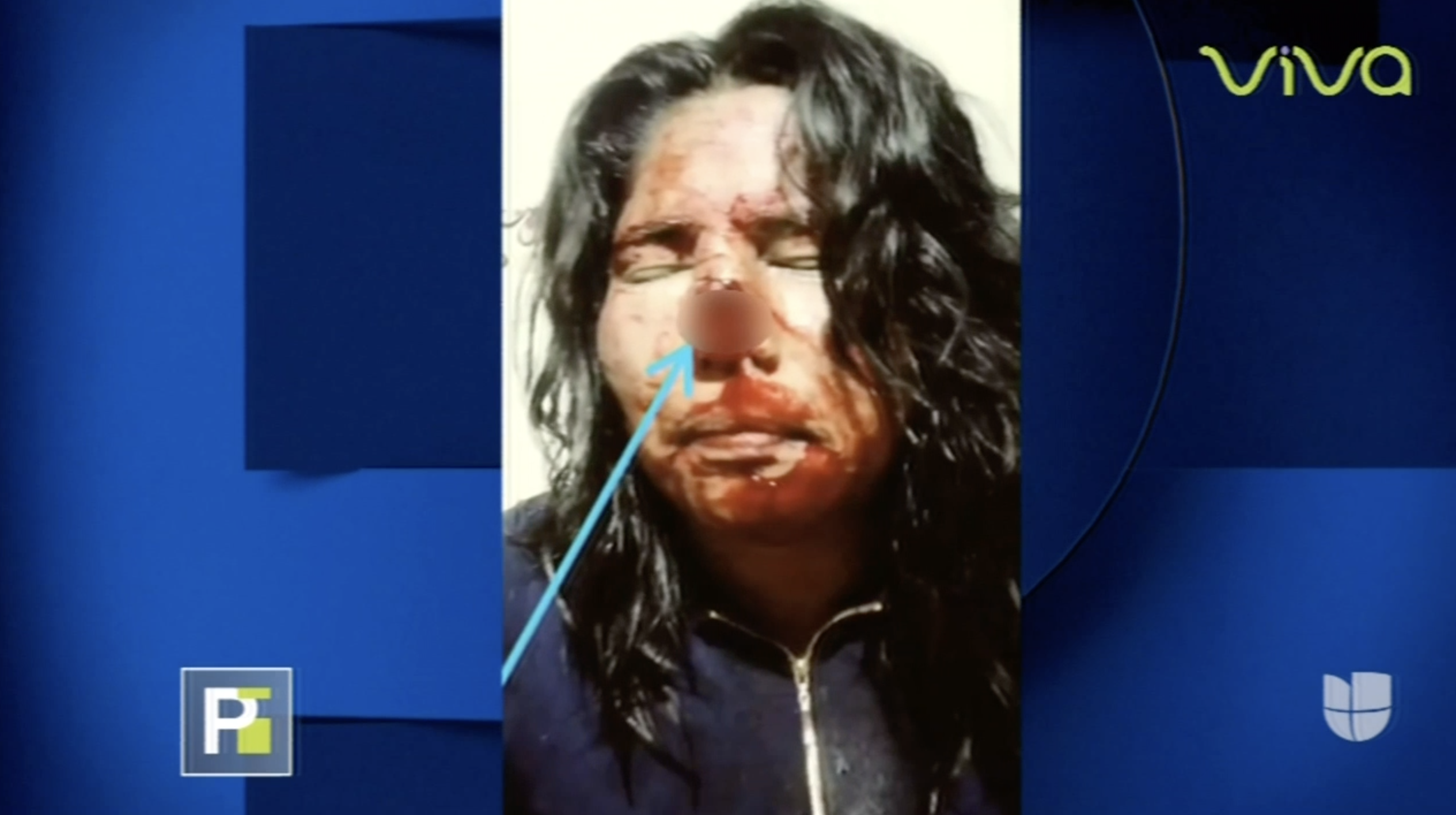 ¡Impactante! Hombre Le Arranca La Nariz De Una Mordida A Su Pareja