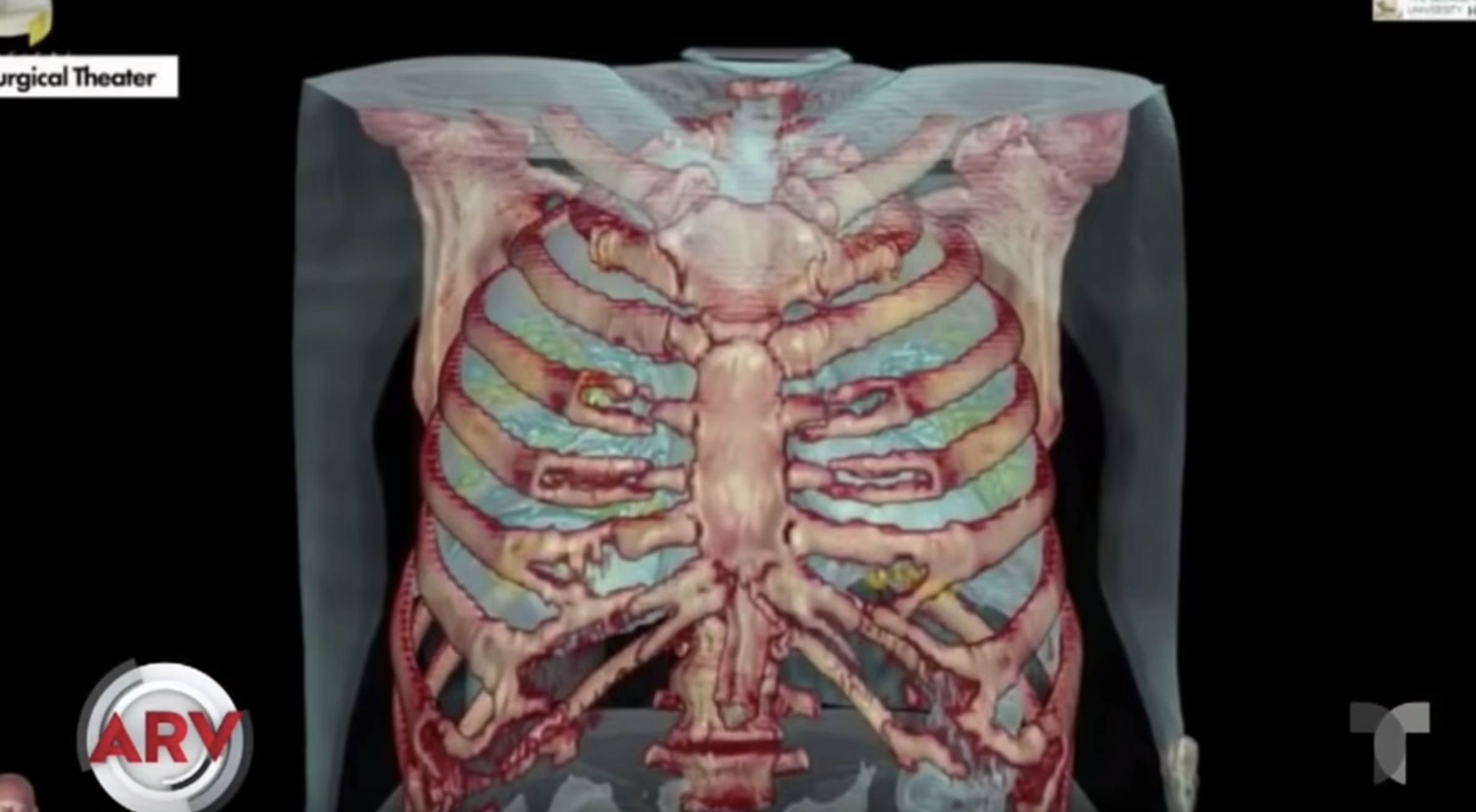 De Esta Manera Es Como El Coronavirus Ataca Tus Pulmones