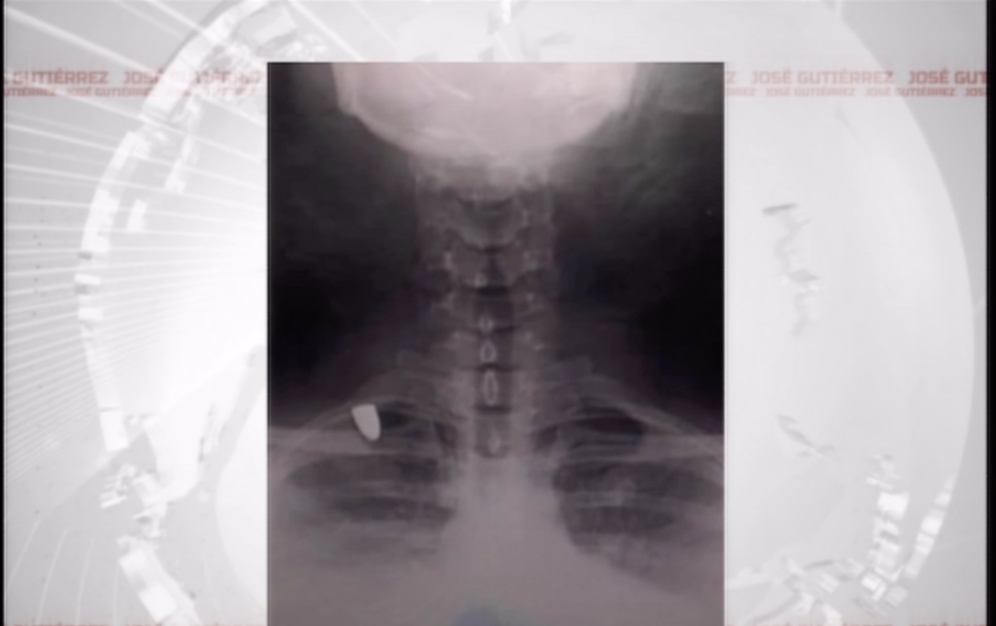 Mujer Resulta Herida En Su Hombro Por Una Bala Perdida Momentos Antes De Año Nuevo