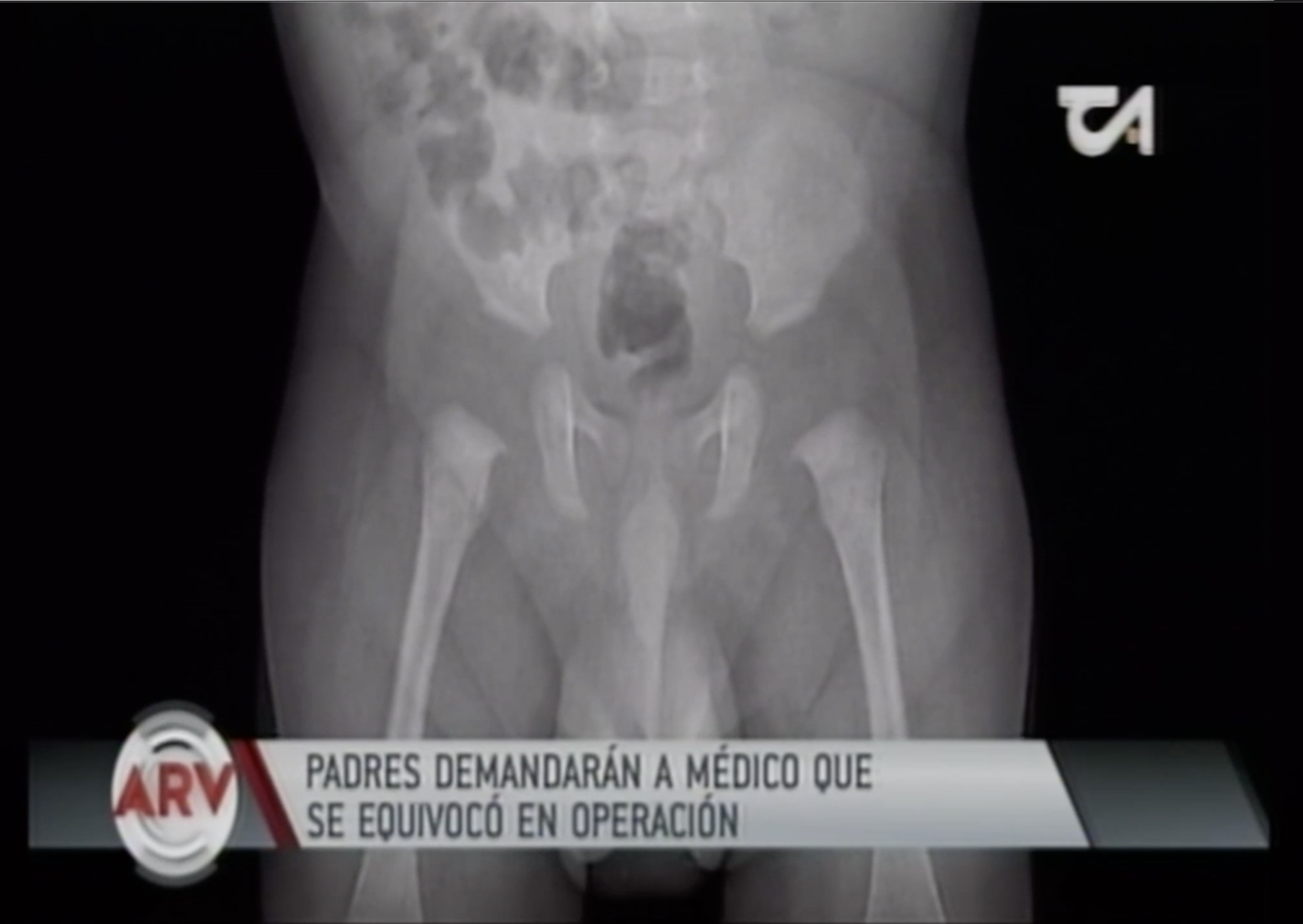 Padres Demandarán A Médico Que Se Equivocó En Operación De Testículo En Un Niño