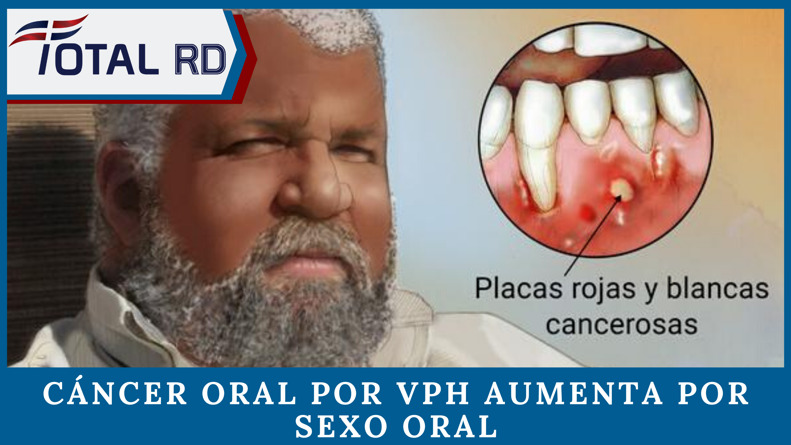 ¡Atención! Cáncer Oral Por VPH Aumenta Por Sexo Oral