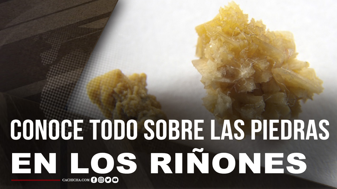 Conoce Todo Lo Relacionado Con Las Piedras En Los Riñones
