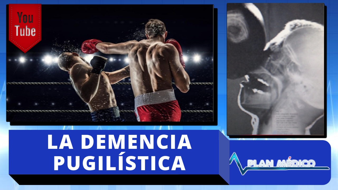 Demencia Pugilística: Causas, Síntomas Y Tratamientos | Plan Medico De Cachicha Tv