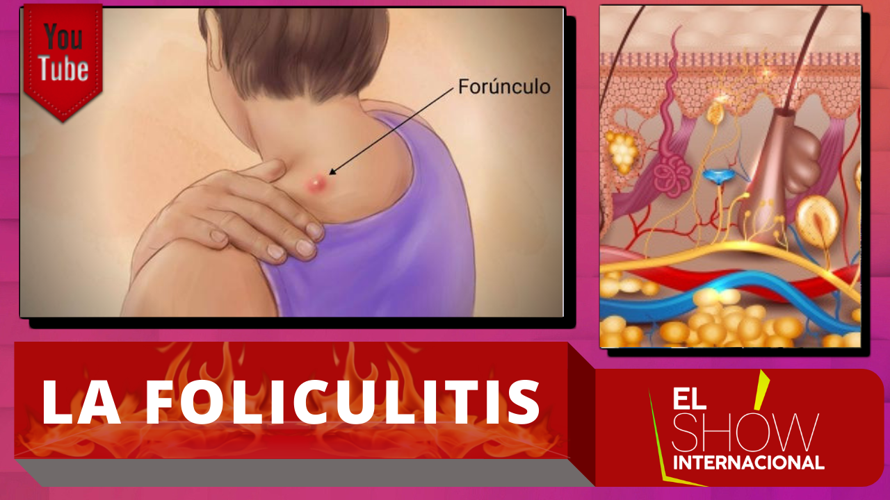 Causas Y Tratamientos De Los Forúnculos O Nacios Ciegos Con La Dermatóloga Katherine Jáquez