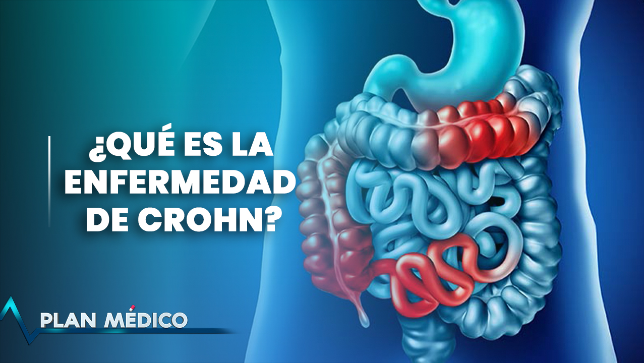 Enfermedad De Crohn | Plan Médico (1/2)