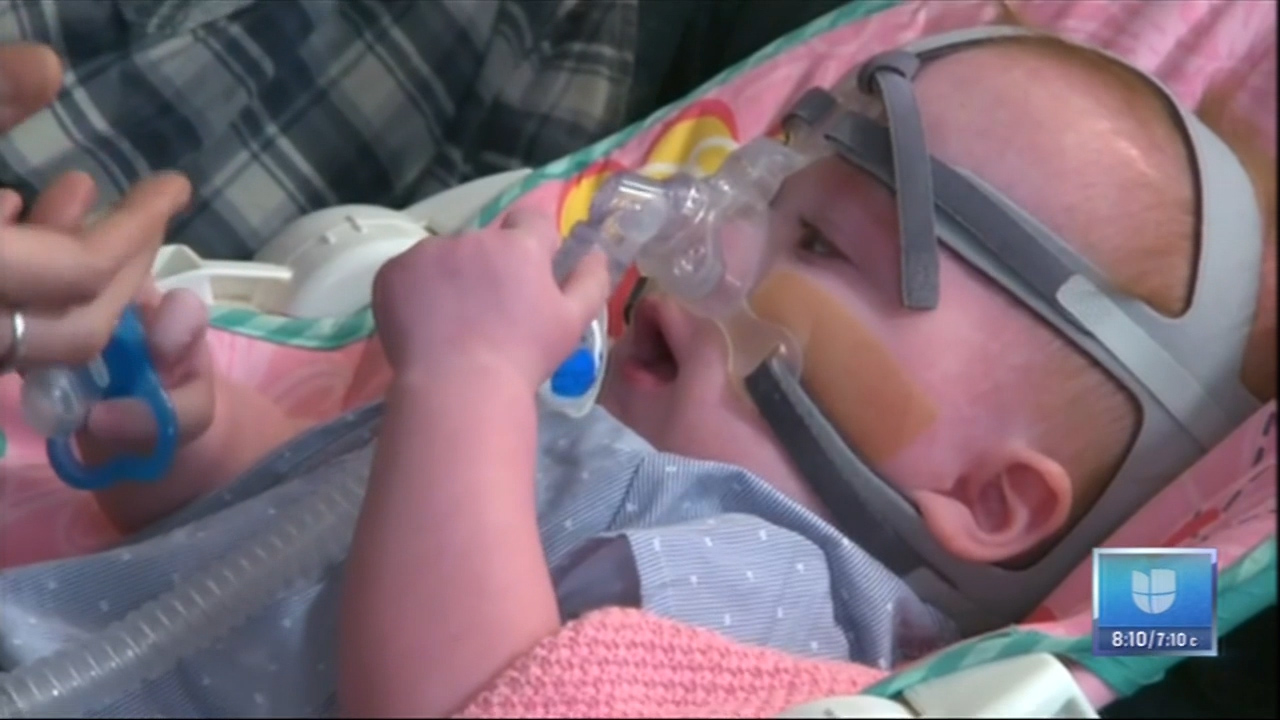 La Bebé Nació Con El Corazón Fuera Del Pecho