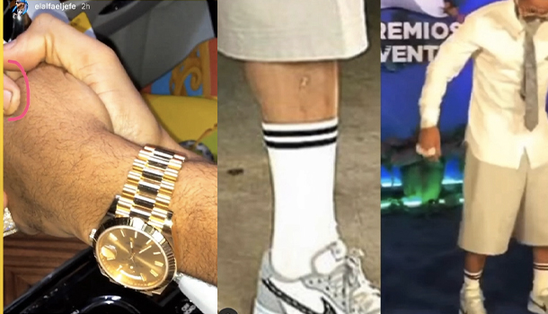 Las Duras Críticas Que Sufrió El Alfa Por Estado De Sus Uñas