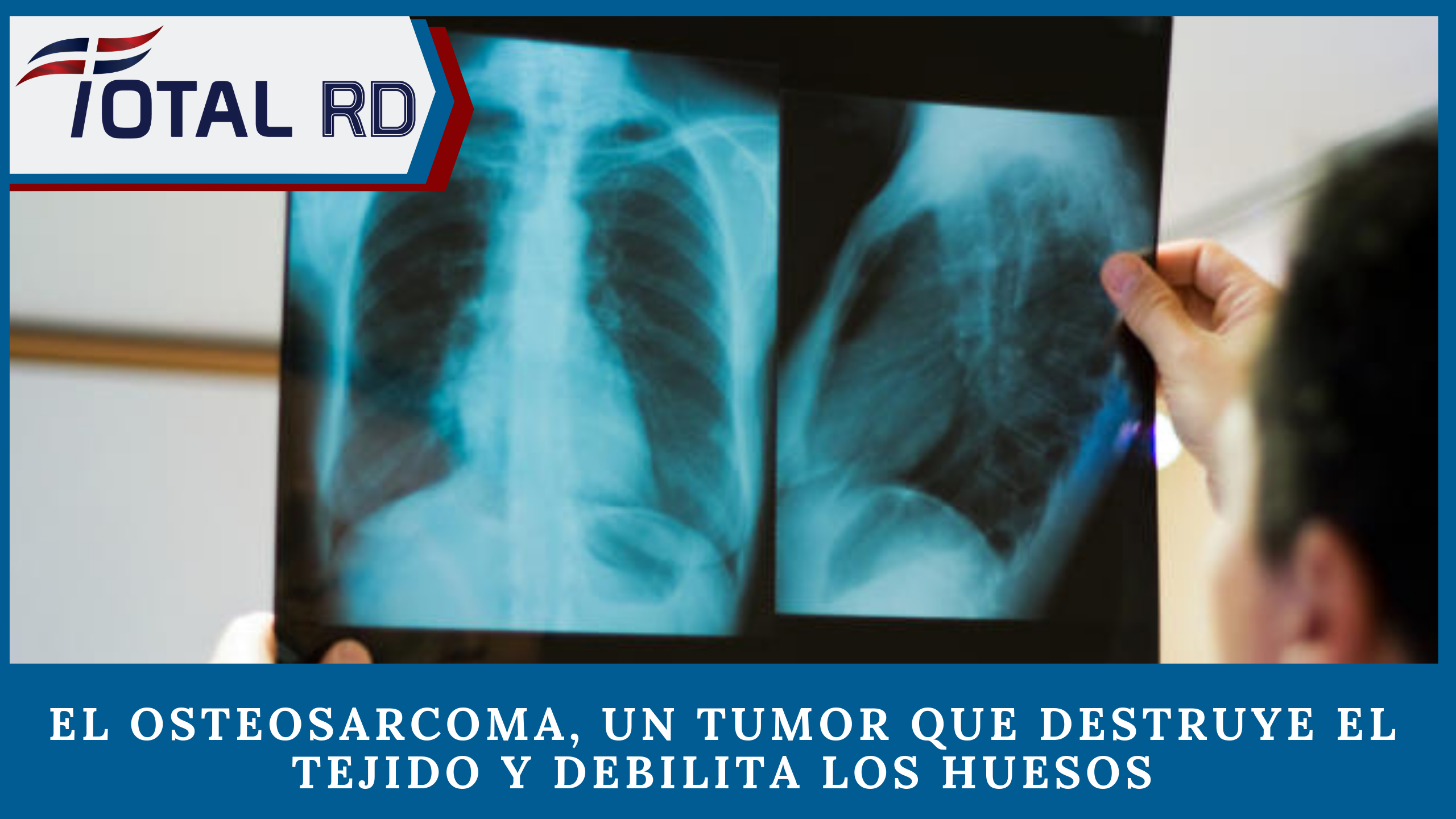 El Osteosarcoma, Un Tumor Que Destruye El Tejido Y Debilita Los Huesos