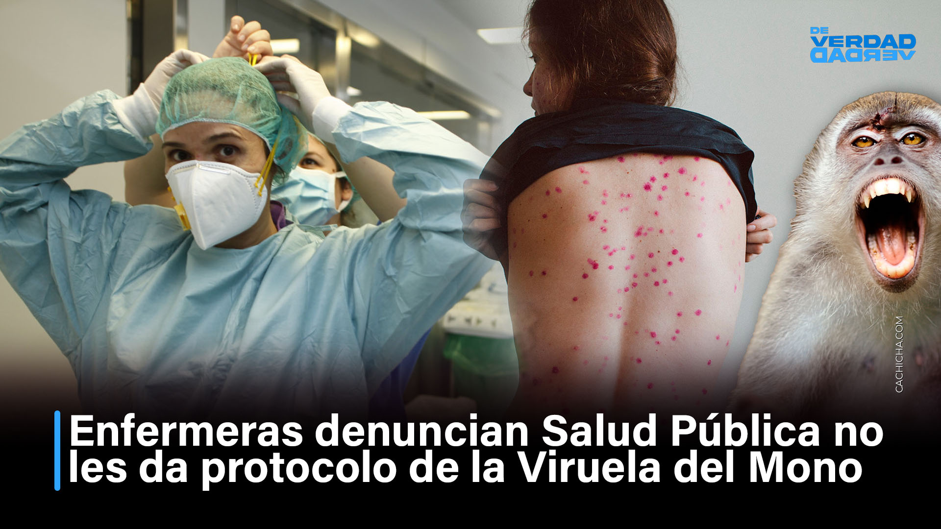 Enfermeras Denuncian Salud Pública No Les Da Protocolo De La Viruela Del Mono