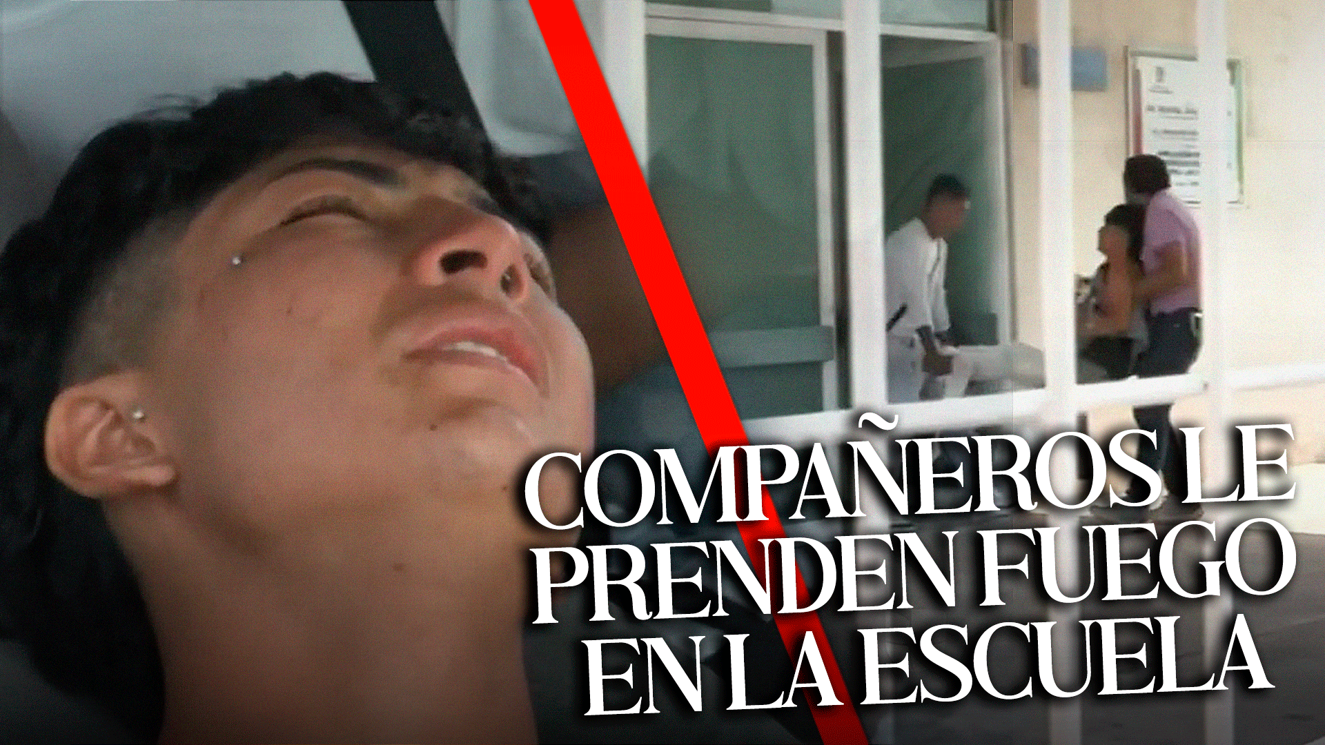 Compañeros Le Prenden Fuego A Un Joven En La Escuela ” Tiene Quemaduras En Los Genitales”