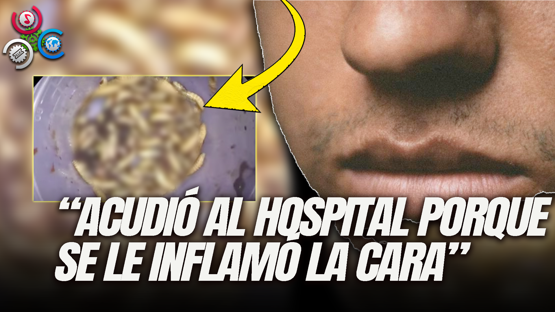 Sacan 150 Gusanos Vivos De La Nariz De Un Hombre En Florida: Un Médico Explica Cómo Pudo Pasar