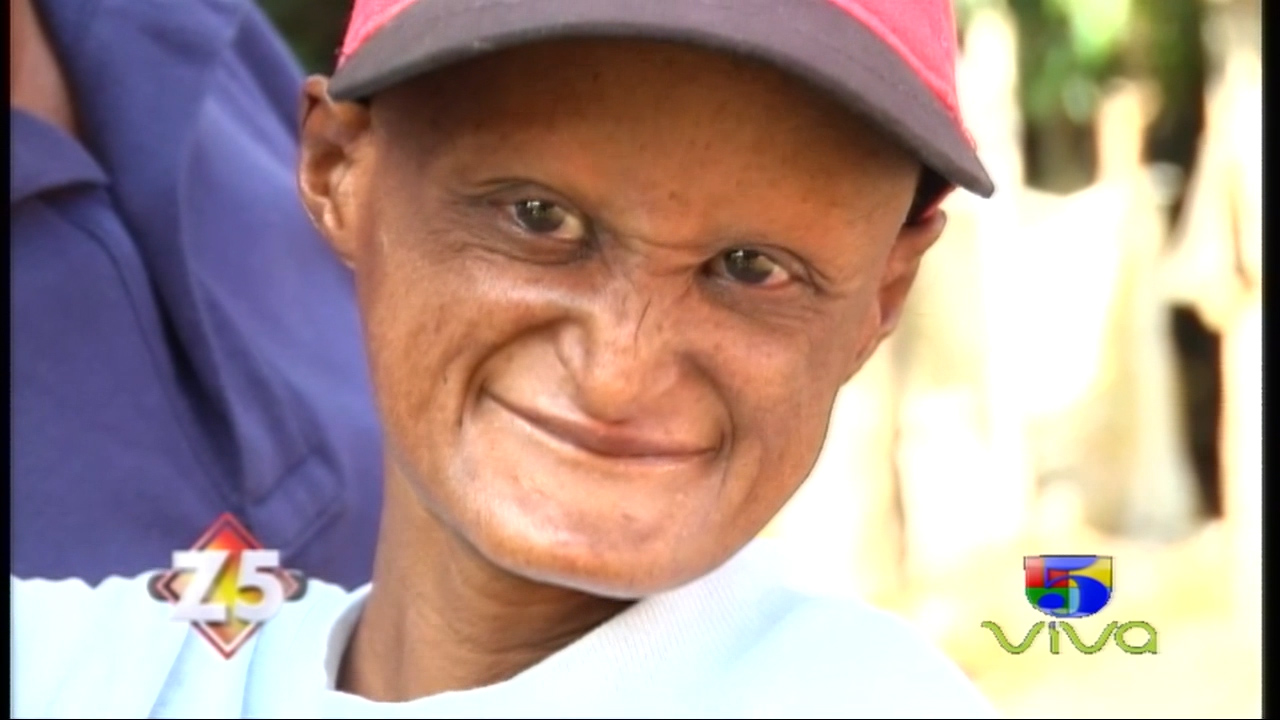 Conoce La Historia De Este Joven Que Con Solo 23 Años Luce Como Un Envejeciente