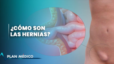 ¿Sabes Qué Es Una Hernia? | Plan Médico (1/2)