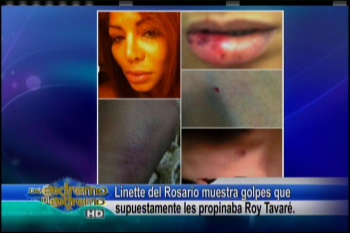 Farándula Extrema: Linette Del Rosario Muestra Golpes Que Supuestamente Les Propinaba Roy Tabaré
